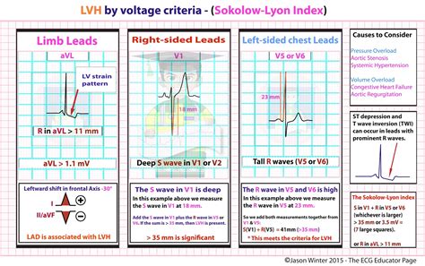 voltage criteria for lvh ekg.